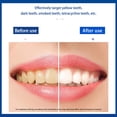thumbnail image 4 of Minnieouse Pegatinas para blanquear los superiores e inferiores para adultos, removedor de placa dental, blanqueador, eliminación de manchas de Type6 NO6 Minnieouse CE001652-01, 4 of 6