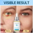 thumbnail image 4 of Tratamiento para ojos LA.PERSONAL Stye Chalazión, 30 ml, con aguacate, 4 of 8