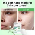thumbnail image 2 of Mascarilla facial IREV Anti Acné con Ácido Salicílico 10 hojas, 2 of 9