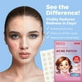 thumbnail image 2 of MEDca Acne Patch – 56 Ct, Hydrocolloid Spot Treatment, 2 Sizes in (Star, Heart) Shapes, 2 of 9