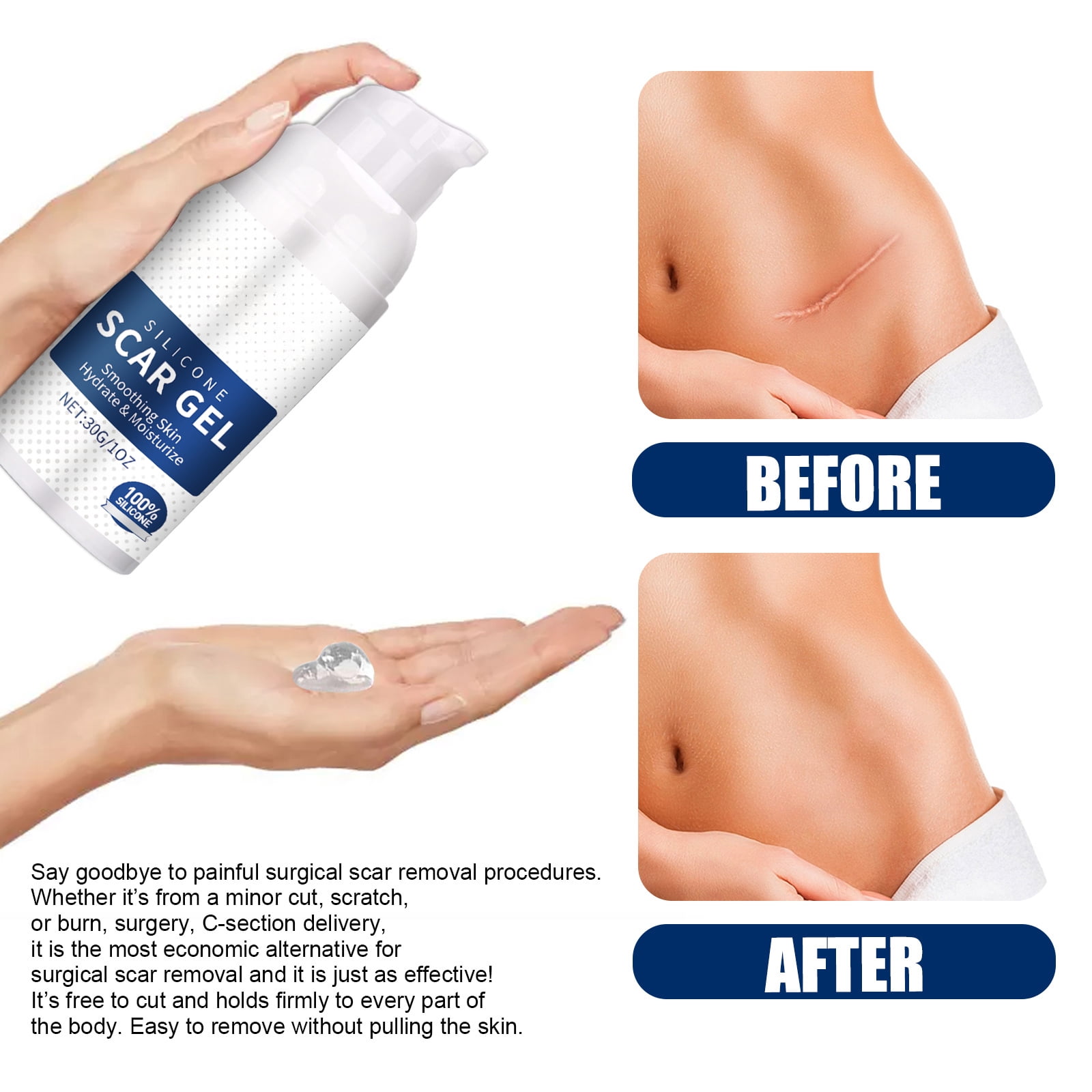 Alvantor Silicone Scar Gel for C-Section, Stretch Marks, Acne, and Surgery Scars