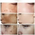 thumbnail image 3 of Crema iluminadora de melasma niacinamida, Reduce la melanina, piel oscura, cloasma, suero para aclarar, desvanece las líneas finas, productos de cuidado coreanos para la cara, 3 of 5