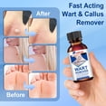 thumbnail image 3 of Eliminador de verrugas AHUIFT de acción rápida 30 ml con 17% de ácido salicílico, 3 of 7