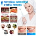 thumbnail image 2 of KIBVOE Plaque Remover for Teeth,Electric Ultrasonic Teeth Cleaner 3 Modes Tartar Remover Teeth Cleaning Kit with LED Light for Adult Kids., 2 of 7