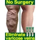 thumbnail image 2 of Pomada para venas varicosas, crema efectiva para aliviar el dolor de araña, vasculitis, flebitis, 2 of 5