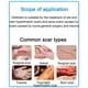thumbnail image 4 of ScarAway Advanced Scar Gel - 15 g, crema eficaz para eliminar cicatrices de acné, estrías y quemaduras, 4 of 10