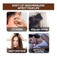 thumbnail image 4 of Psoriasis Dandruff Treatment for Scalp, Anti Itching Follicle Booster Stimulator Smoothing Nourishing Hair Serum, 4 of 5