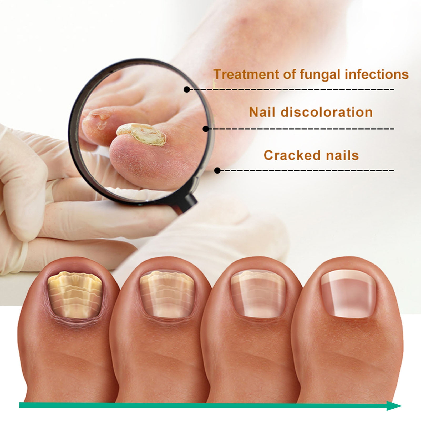 Fungal Nail Infections: Symptoms, Causes And Treatment