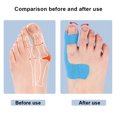 thumbnail image 2 of Corrector Juanetes Separador Dedos Los Pies Autoadhesivo Herramienta para El Cuidado 10 Uds. Azul, 2 of 7
