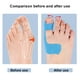 thumbnail image 2 of Corrector Juanetes Separador Dedos Los Pies Autoadhesivo Herramienta para El Cuidado 10 Uds. Azul, 2 of 7