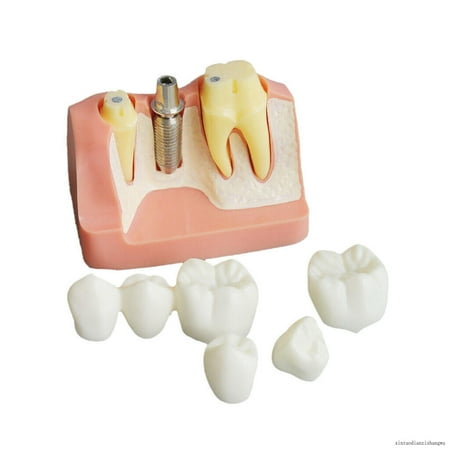 

Dental Equipment Implant Analysis Crown Bridge Demonstration Teeth Model