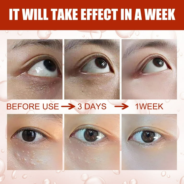 Xerdsx Speedy Milia Remover 30ml Milia Remover Under Eyes