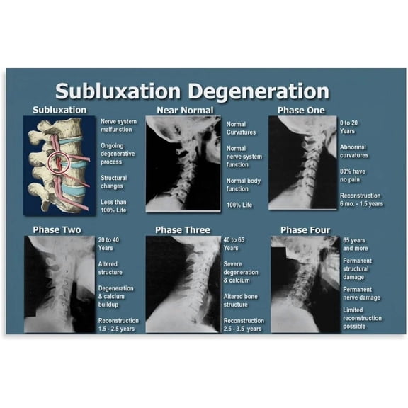 Spinal Degeneration Nerve Subluxation Chart Poster (3) Canvas Print Wall Art Decoration Living Room Office Bedroom