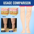 thumbnail image 4 of Crema para varices Renhe Ingenuity para piernas (2 unidades), 4 of 8