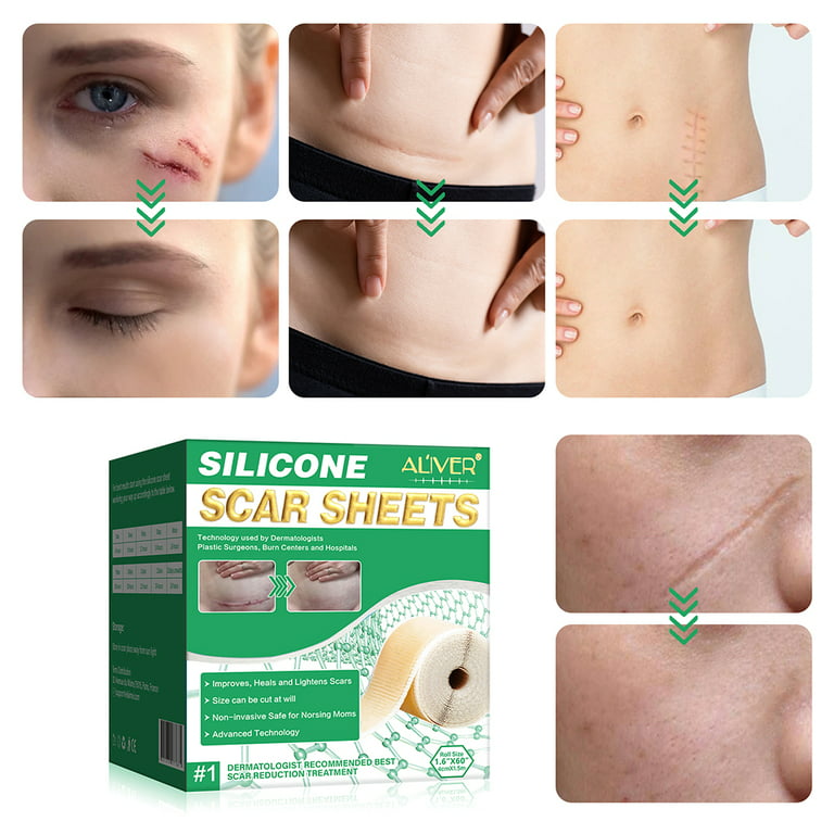 Silicone Scar Sheets, Silicone Scar Tape Roll 1.6 x 60(4 Month Supply),  Reusable And Effective Scar Removal Silicone Scar Strips For Scars Caused  By C- Section, Burn Scars, Surgery, Acne : 