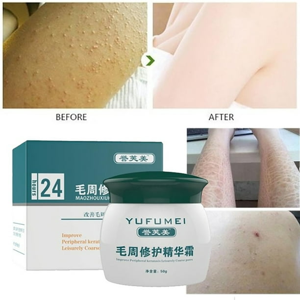 Hevirgo 50g Whitening Repair Curing Chicken Fish Scale Snake Skin Cream Body Lotion