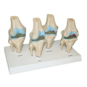 Vision Scientific 4 Stages of Knee Joint Diseases Model