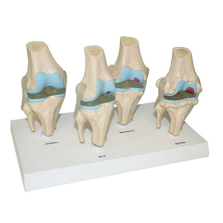 Vision Scientific 4 Stages of Knee Joint Diseases Model
