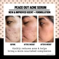thumbnail image 4 of Serum Peace Out Skincare Acne 2% Ácido Salicílico 30 ml, 4 of 6