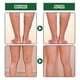 thumbnail image 4 of Minnieouse 12 piezas/caja removedor de varices parches de eliminación de venas de ingredientes herbales Protección de la piel, 4 of 6