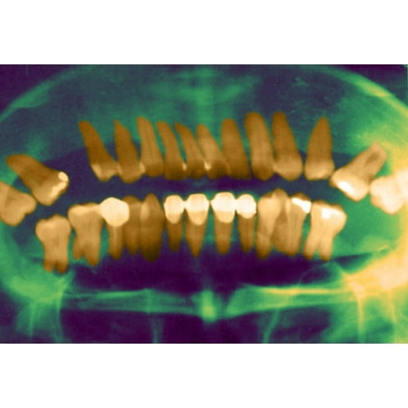 - Panoramic Dental X-Ray Stretched Canvas - Science Source (36 x 24)