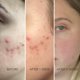 thumbnail image 4 of VQM PLUINO Skin Care Booster Capsule Serum facial Esencia hidratante Pantenol y niacinamida. Hidratante facial para pieles sensibles y con acné Cuidado de la piel coreano 25 g/0,88 fl.oz, 4 of 5
