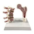 thumbnail image 1 of Modelo de Anatomía de Osteoporosis de Fémur Humano para Suministros Escolares de Enseñanza en El Hogar, 1 of 9