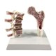 thumbnail image 1 of Modelo de anatomía de osteoporosis de fémur humano Aprenda accesorios de esqueletos Herramienta educativa para suministros escolares enseñando hogar, 1 of 8