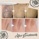 thumbnail image 2 of Lápiz para eliminar lunares, pecas y manchas oscuras de envejecimiento instantáneo - Herramientas de belleza, 2 of 2