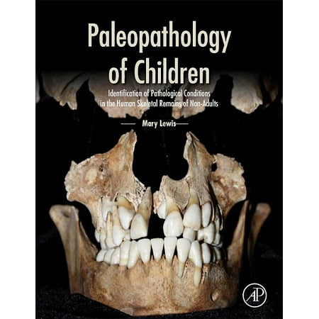 UPC: 9780124104020 | Paleopathology of Children: Identification of Pathological Conditions in the Human Skeletal Remains of Non-Adults (Hardcover)