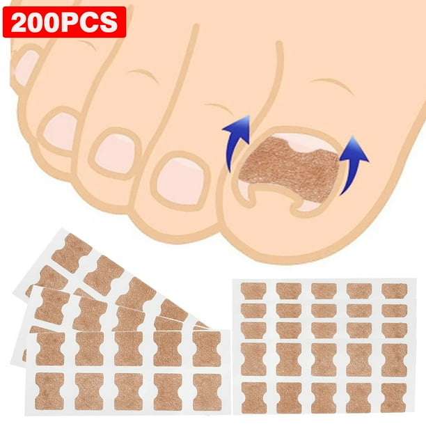 Yiget 200Pcs Toenail Corrector Patch,Ingrown Toe Nail Correction