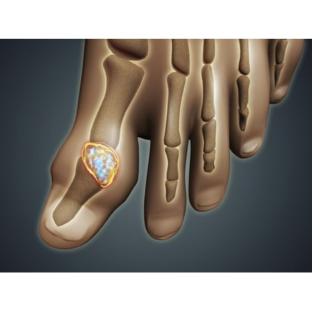 Conceptual image of gout in the big toe Gout is a form of inflammatory arthritis that causes sudden severe pain swelling and tenderness of joints Poster