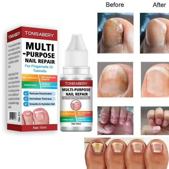 Toenail Fungus Treatment,nail Repair For Fingernails Toenails,strengthen Renew Damaged Broken Nails