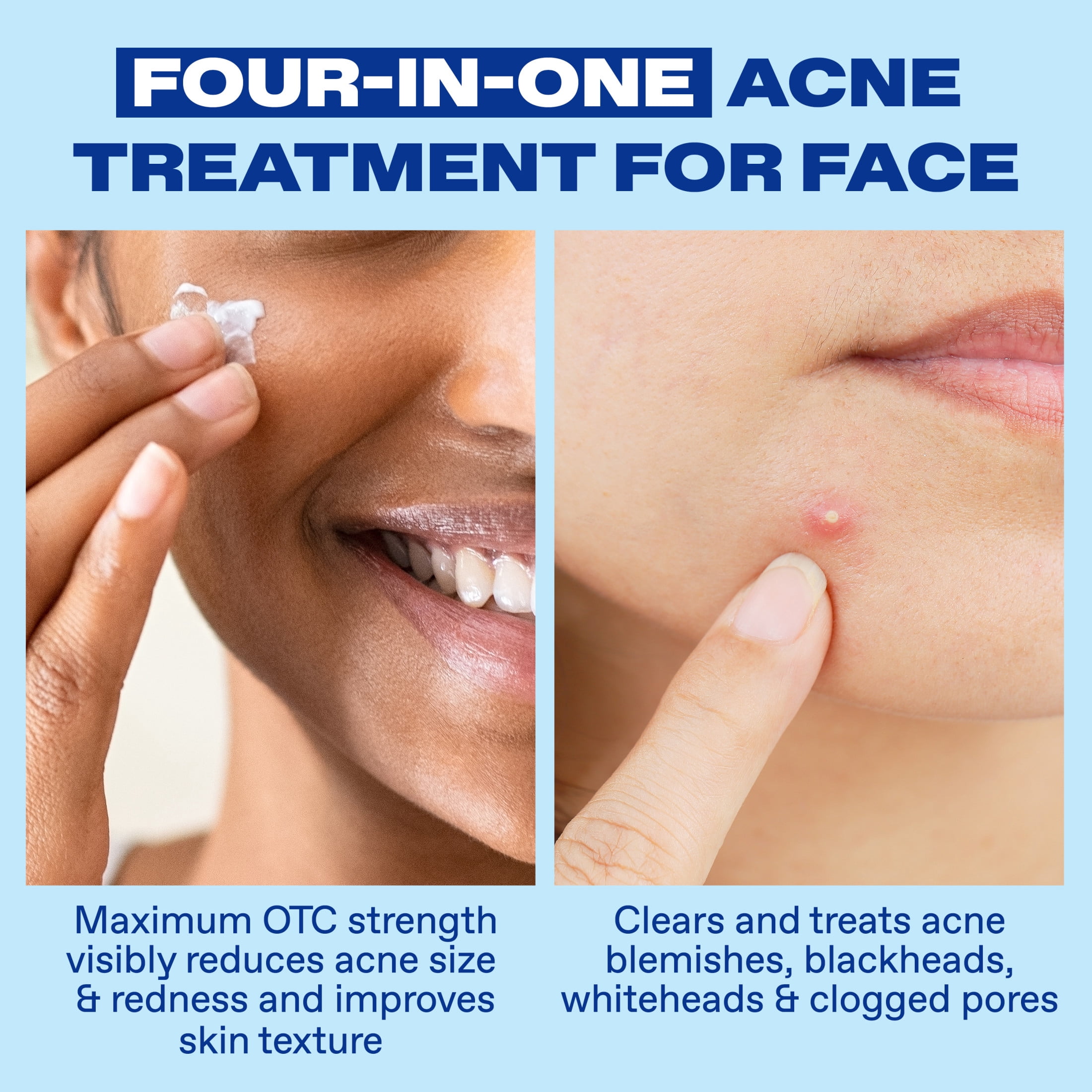 Differin Acne Spot Treatment with 10% Benzoyl Peroxide, Maximum Strength, Fast-Acting, Acne Treatment for Face & Body​, 1 oz