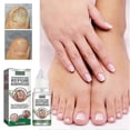 thumbnail image 2 of Essential Oil Nail Fungus Repair Liquid Nail Thickening Discoloration Off Soft Nail Thickening Type O, 2 of 5
