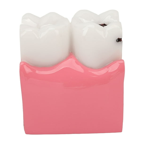 Dental Caries Model,Dental Caries Model Tooth Dental Caries Study Aid ...