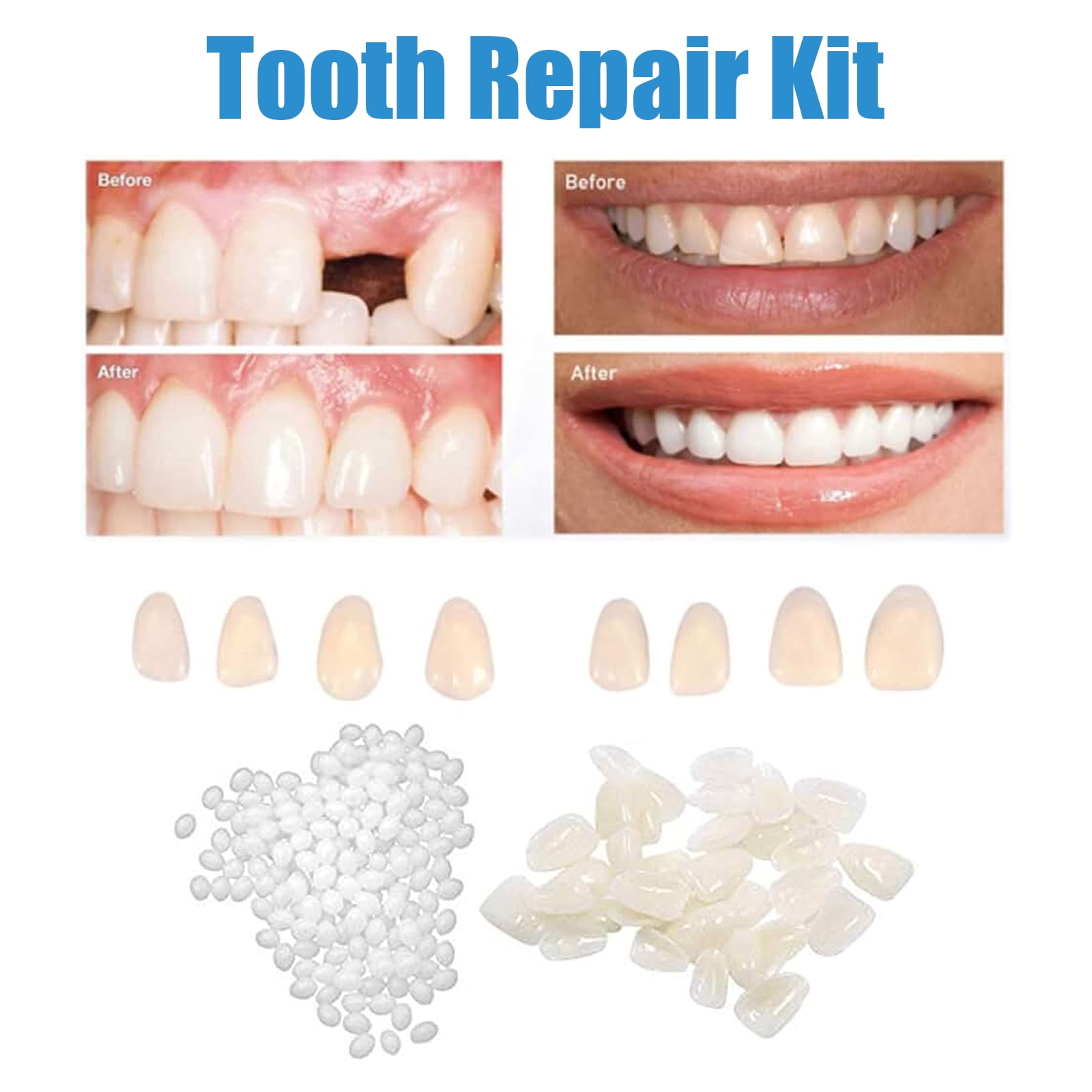Alvantor Tooth Replacement Kit with Repair Beads for Missing and Broken Teeth, 1.05 oz, 8PC