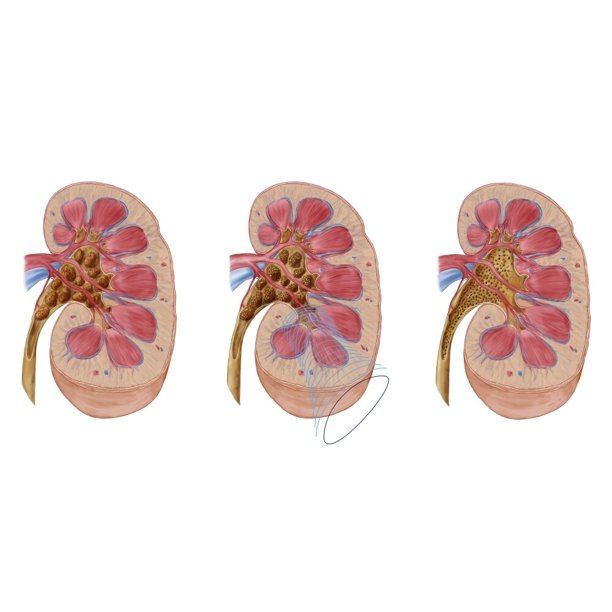 Comparison of different sized kidney stones in the human kidney. The
