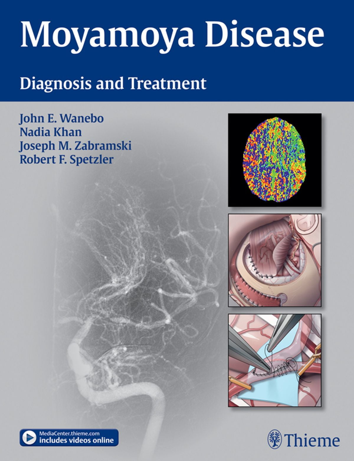Moyamoya Disease eBook