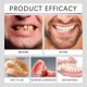 thumbnail image 5 of Juego de prótesis dentales premium, juego de prótesis dentales con revestimiento de silicona avanzado, carillas dentales cosméticas para una sonrisa perfecta., 5 of 5