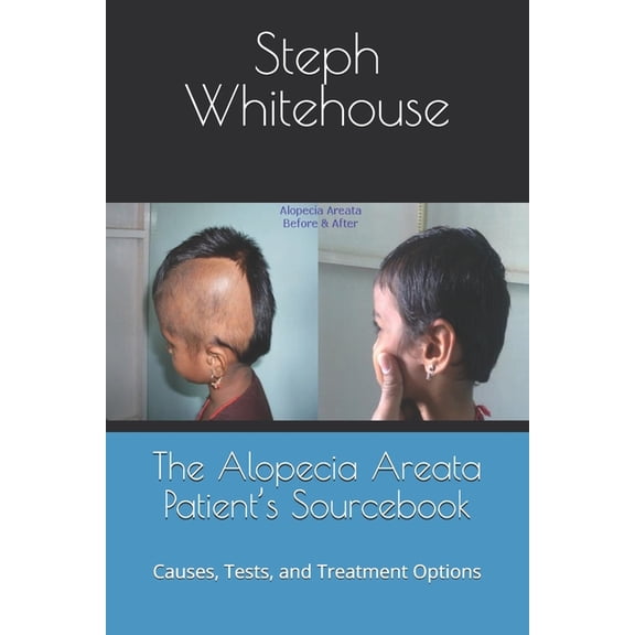 The Alopecia Areata Patient's Sourcebook: Causes, Tests, and Treatment Options, (Paperback)