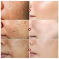 thumbnail image 4 of Suero Facial para reducir los poros, repara los poros grandes, ácido salicílico, antiarrugas, Control de aceite, blanqueamiento, cuidado de la piel, 4 of 5