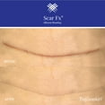 thumbnail image 3 of Rejuvaskin Scar Fx Silicone Sheeting - 1" x 12"  - 100% Healthcare Grade Silicone - Physician Recommended, 3 of 5