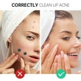 thumbnail image 4 of Acne Patches 90 Patches (2 Sizes) JVR Acne Medical-Grade Hydrocolloid Acne Patches for Face Invisible Pimple Patches Sticker with Absorbing Cover for Acne Treatment for All Skin Types, 4 of 8