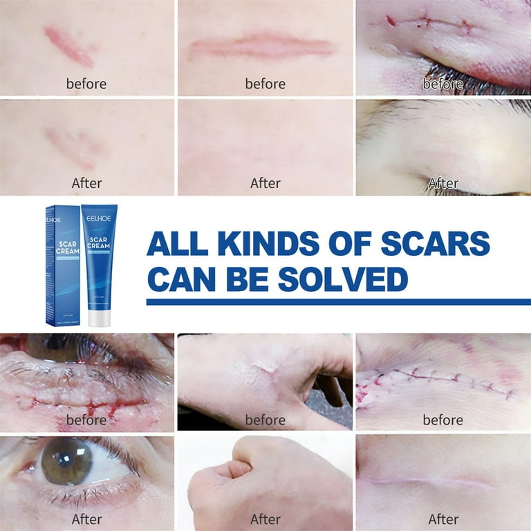 Scar on sale fading cream