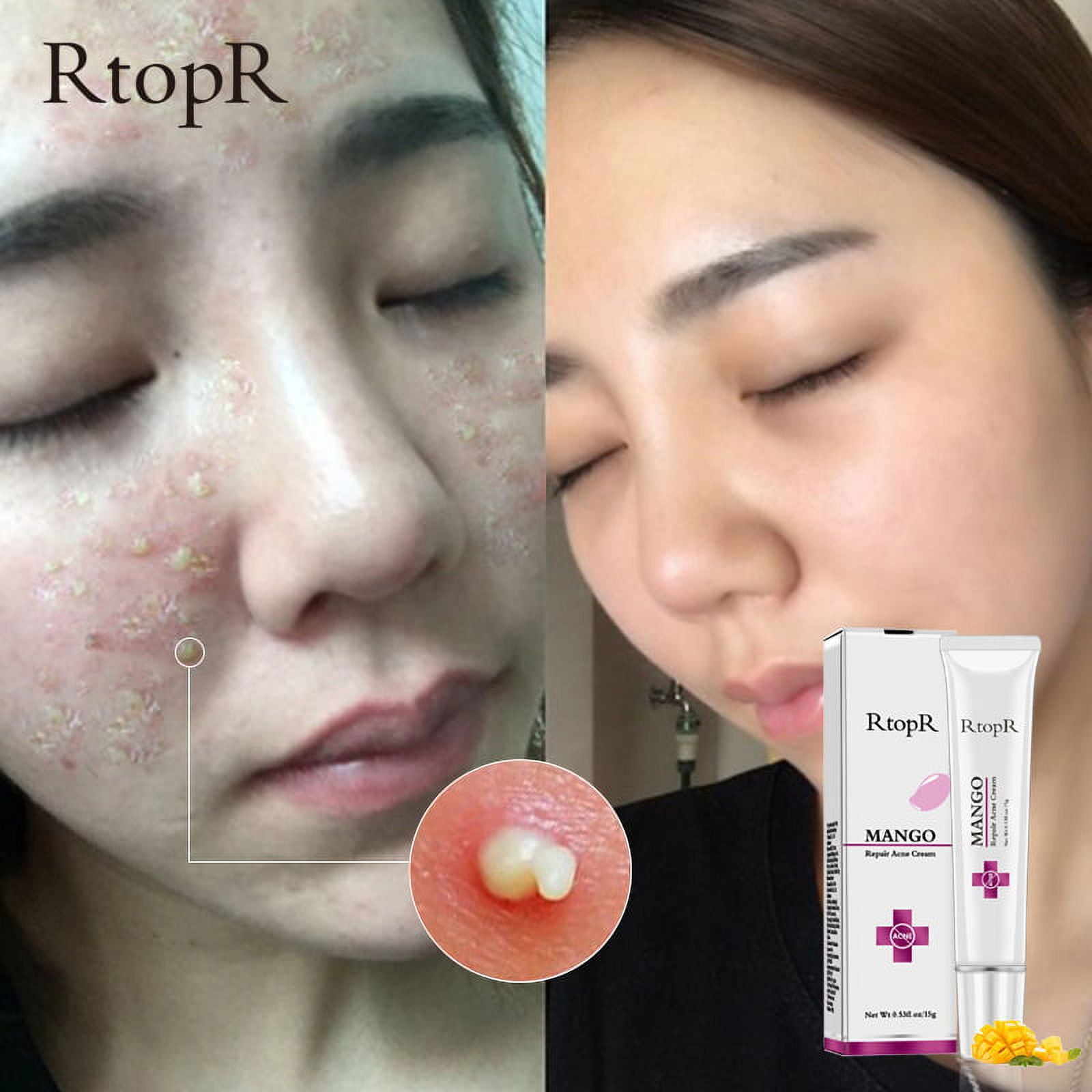 Mango repair cheap acne cream