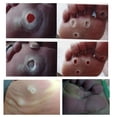 thumbnail image 2 of Chicken Eye Patch To Remove Hard Calluses Warts Hand And Foot Calluses Foot Pads Easy To Apply, 2 of 7