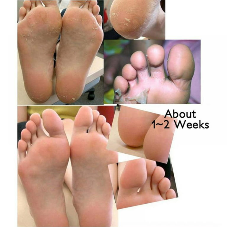 Putimi Feet Exfoliating Foot Masks Pedicure Socks Exfoliation Scrub Remove  Dead Skin Heels Foot Peeling Anti Cracked Foot Care - Feet Care - AliExpress