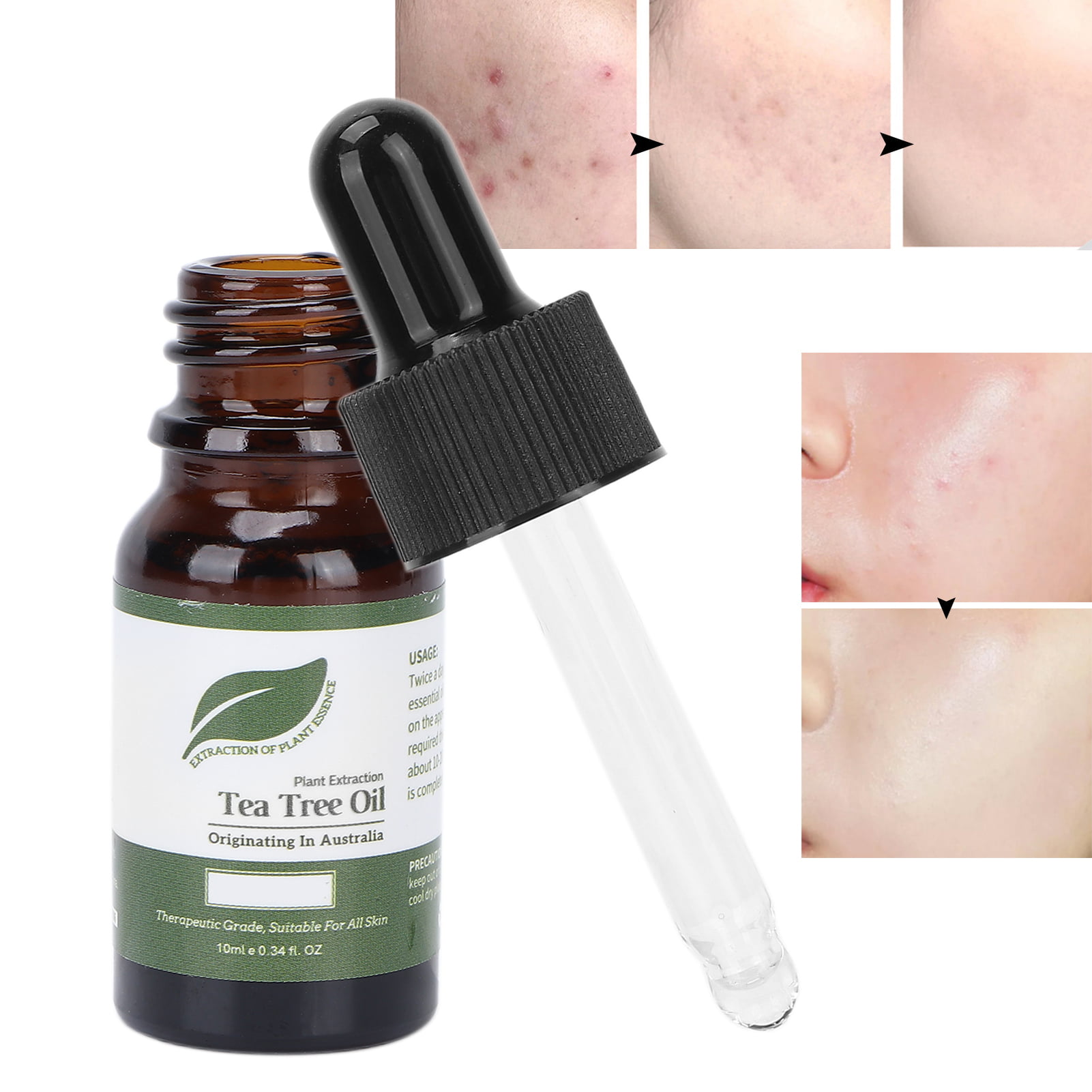 tea tree oil acne scars