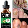 thumbnail image 1 of 7DAYS Tratamiento de hongos en las uñas Esencia Suero Cuidado Cuidado de manos y pies Eliminación Gel reparador Antiinfeccioso, 1 of 4